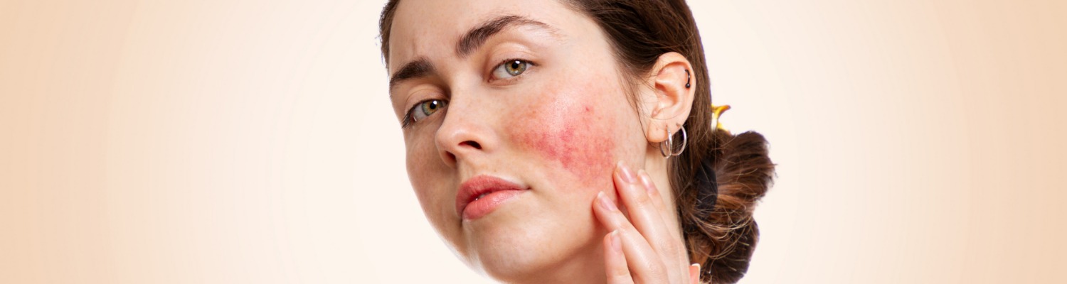 Rosacea Triggers and How to Avoid Them for Clearer Skin