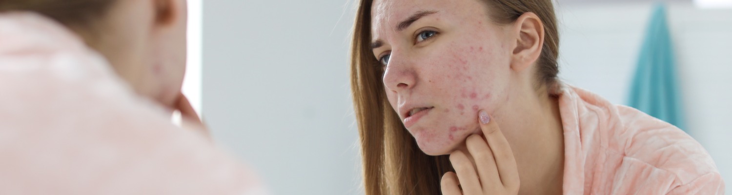 Seasonal Variations in Acne