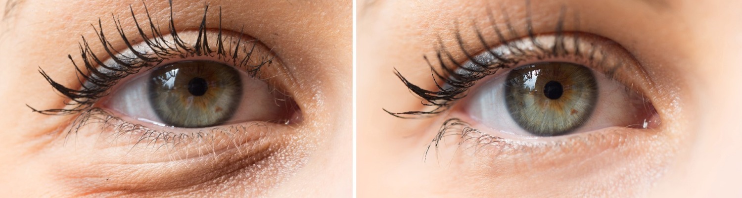 Sunken Tear Troughs: How to Get Rid of Dark Circles