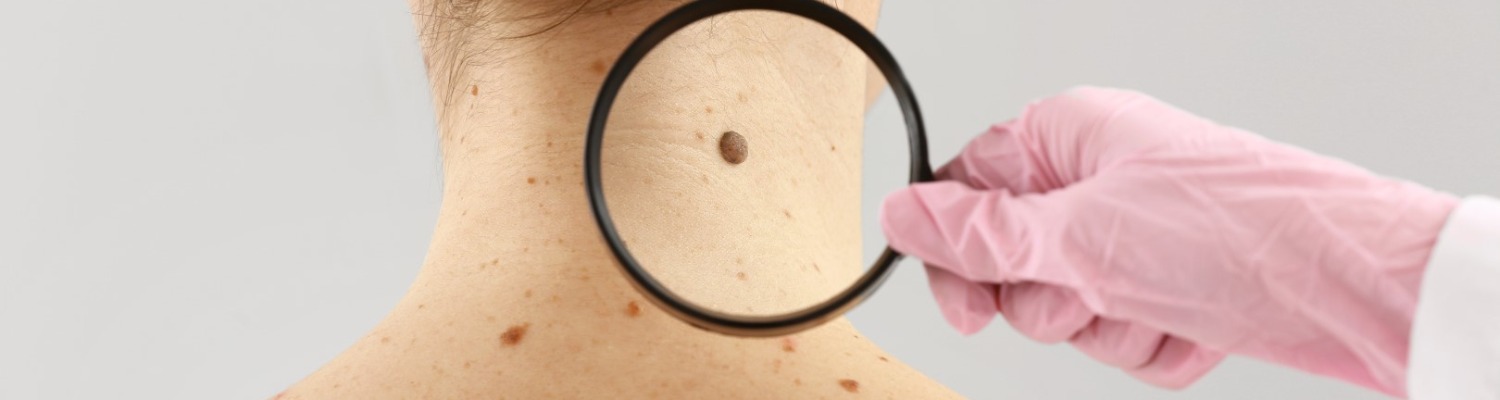 The Facts About Moles