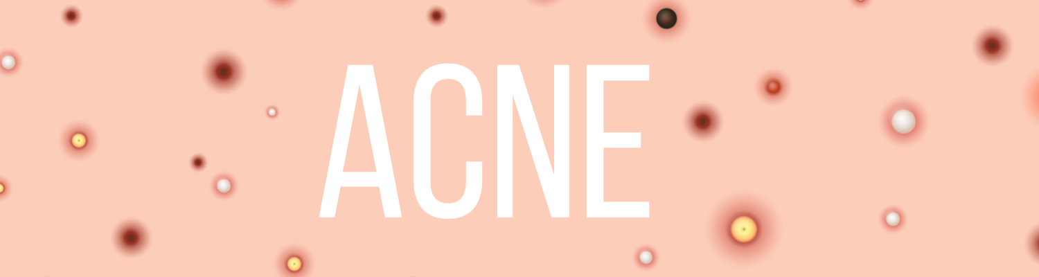 The Treatment That Helped Me Say Goodbye to Acne