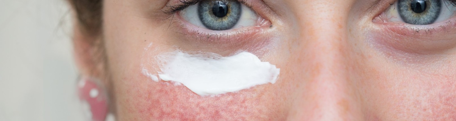 Treating Rosacea With Skin Creams