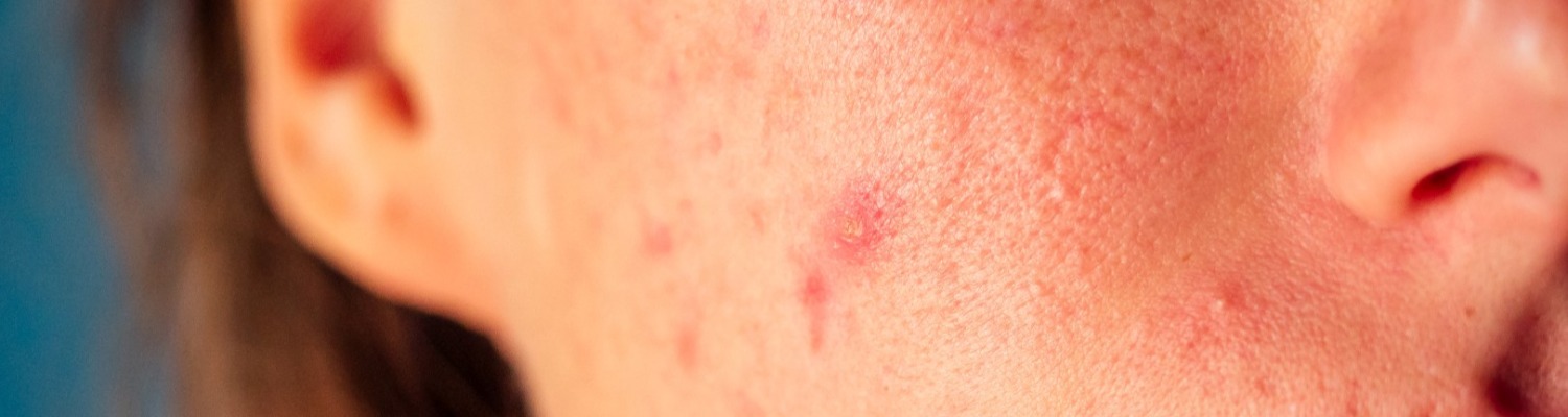 What is the Best Treatment for Acne?