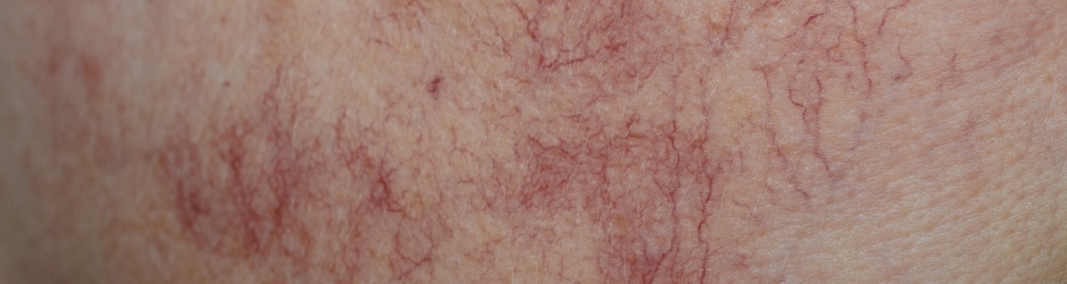 Treatment of Facial Veins - Laser and Light Based Treatments