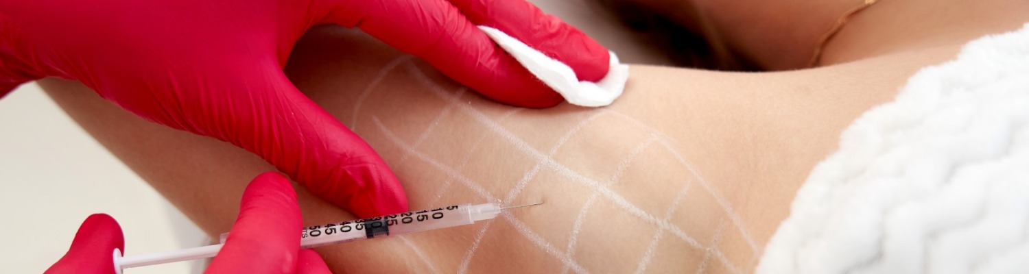 Treatment Options for Excessive Underarm Sweating
