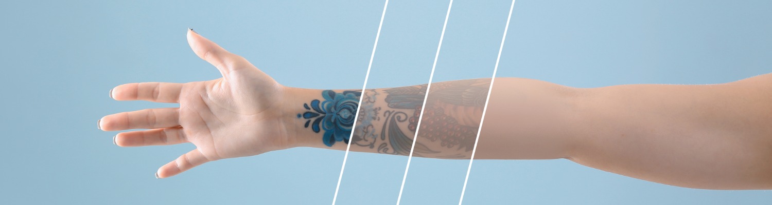 What a Nurse Wants You to Know About Tattoo Removal