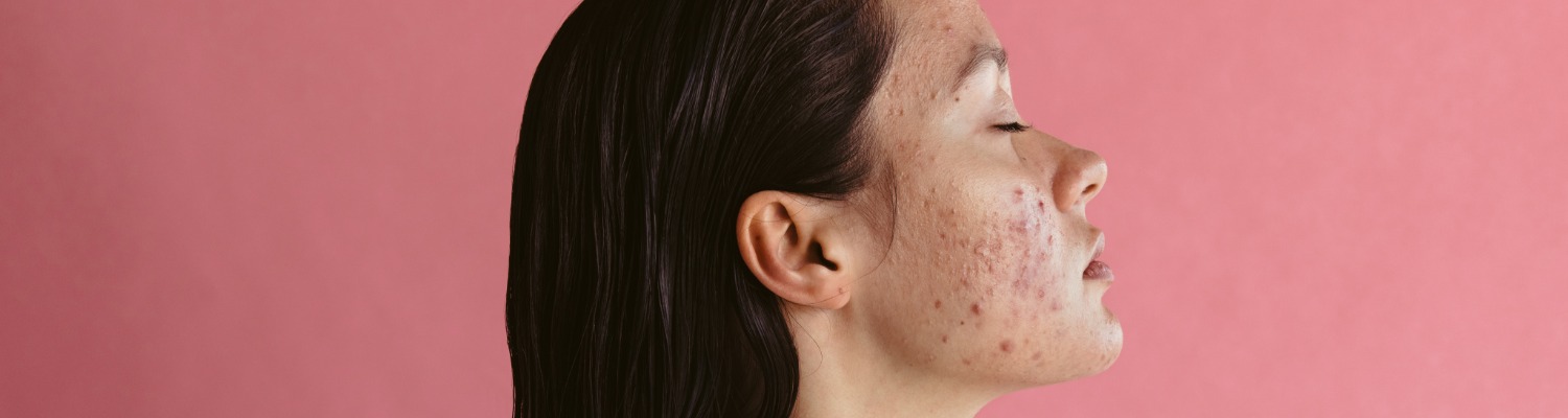 What Is the Best Treatment for Acne Scars?