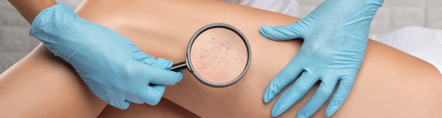 Who Can Inject Leg Spider Veins By Microsclerotherapy?