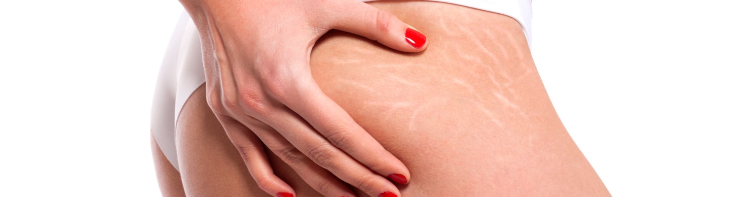 Why Do Some Stretch Mark Creams Work?