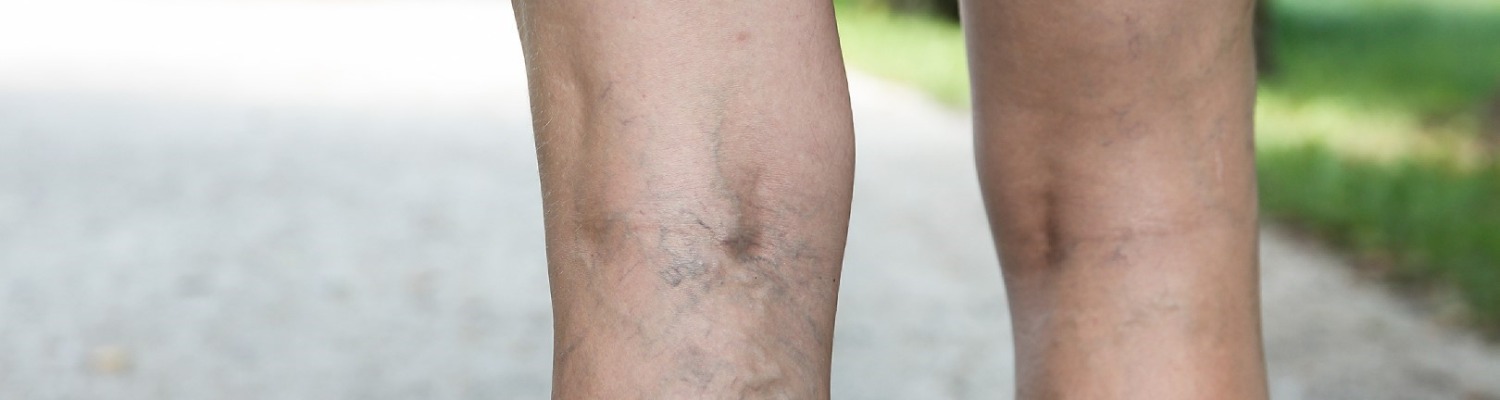 Your No-Nonsense Guide to Removing Thread Veins
