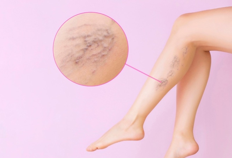 10 Things You Didn’t Know About Varicose Veins
