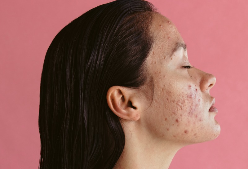 3 Ways to Treat Acne Scarring