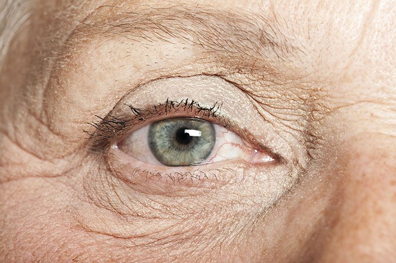 Laser Eye Surgery Is Not Always the Best for Those Over 40