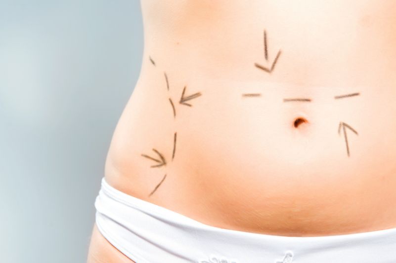 Fat Transfer Through Microcannular Liposuction Explained
