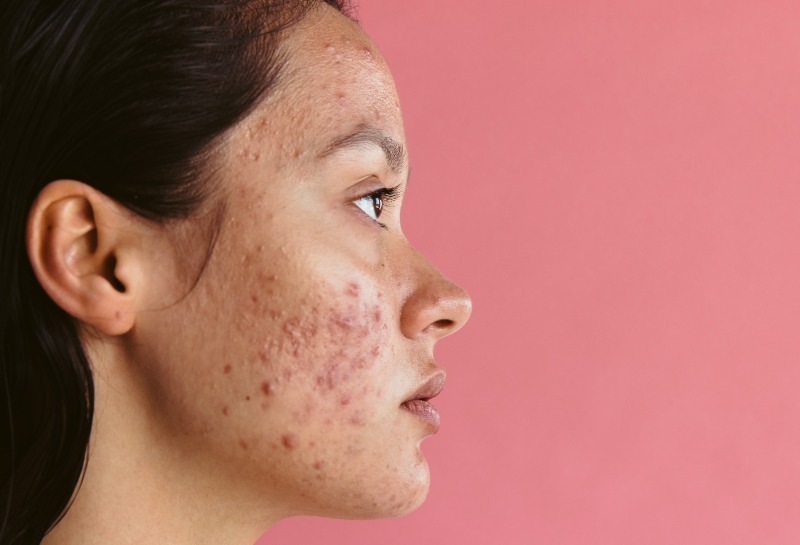 Acne: How You Can Have a Future With Clear Skin