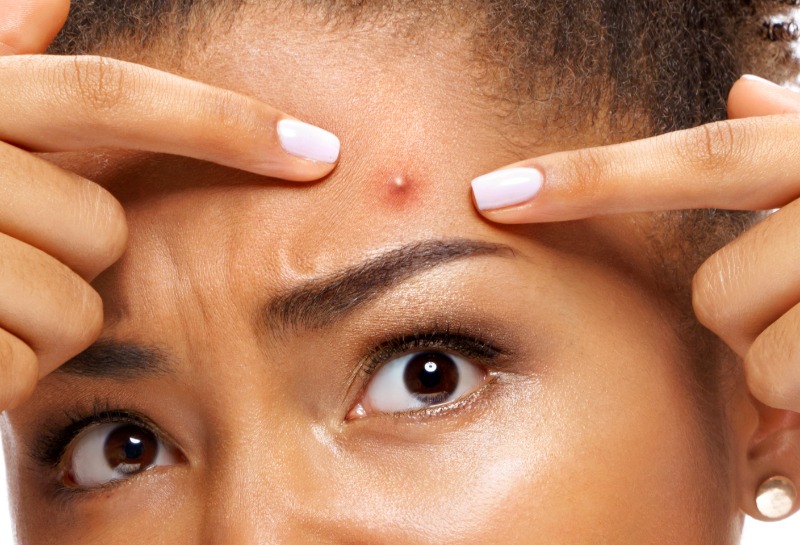 Acne Myths You Need to Ignore Immediately