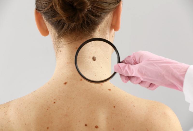 Be Alert for Moles After a Hot Summer