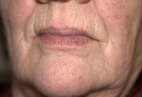 Botox for a Dimpled Chin... What You Need to Know