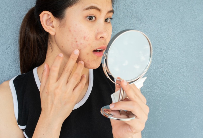 Can Dermapen Micro-Needling and PRP Help Acne Scars?