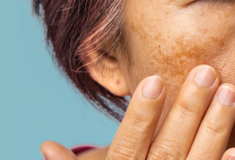 Do Away With Dark Spots: Treating Hyperpigmentation