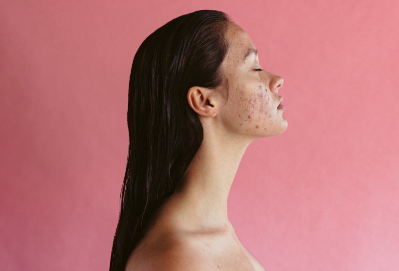 Do We Inherit Acne?