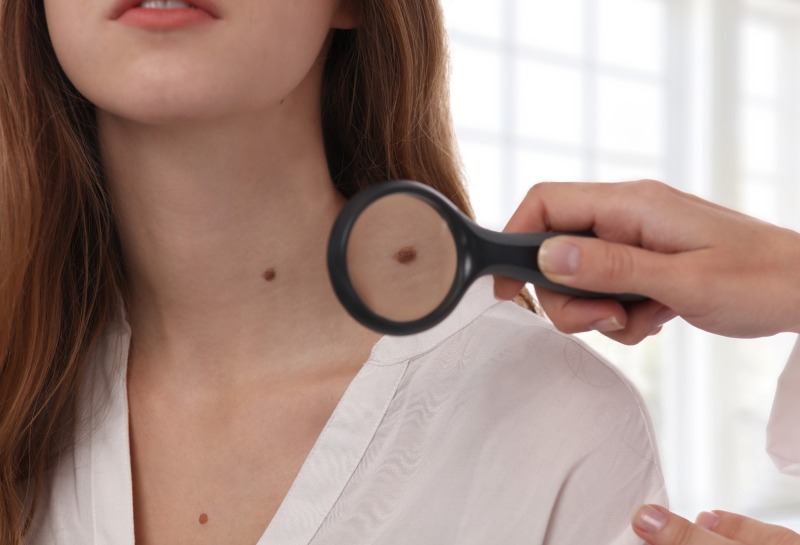 Fed up of Unsightly Skin Tags? Try Smartxide Dot