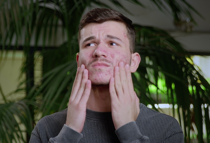 How to Shave When You Have Acne