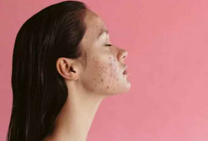 Hydrafacial for Acne