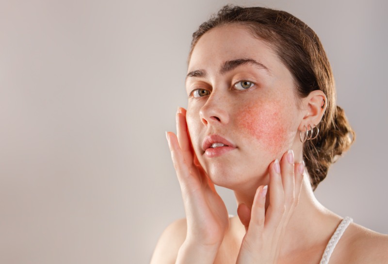 Rosacea Relief: Exploring Hydrafacial as a Treatment Option