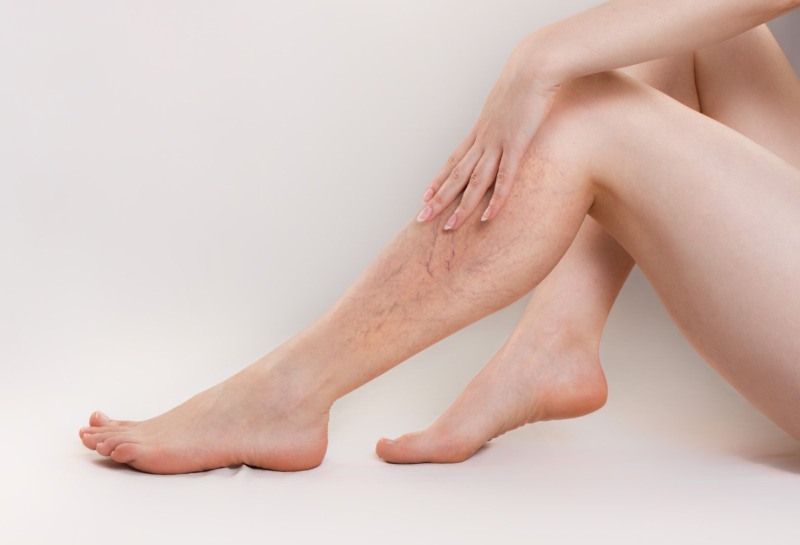 Increasing the Effectiveness of Laser Thread Vein Treatment