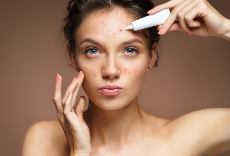Is This the Best At-Home Treatment for Acne Scarring?