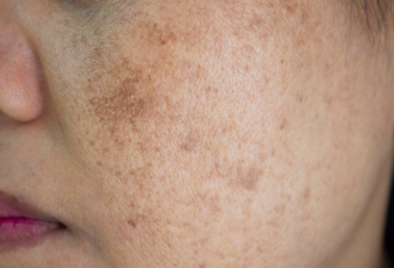 What Is Melasma?
