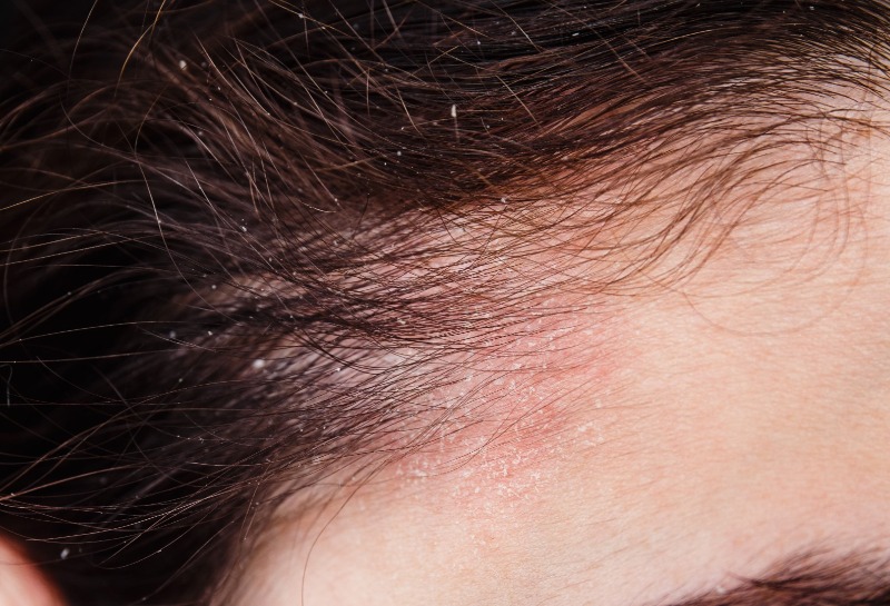 Mesotherapy for Hair Loss and Scalp Seborrhoea