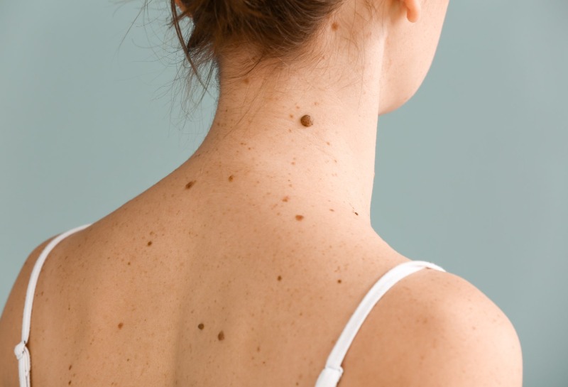 Everything You Need to Know About Mole Removal