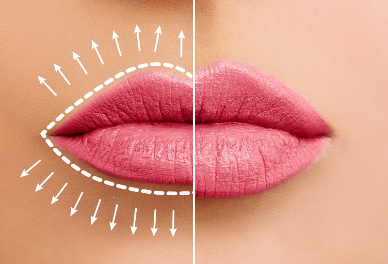 Lip Fillers - Why No Two Lips Are Alike