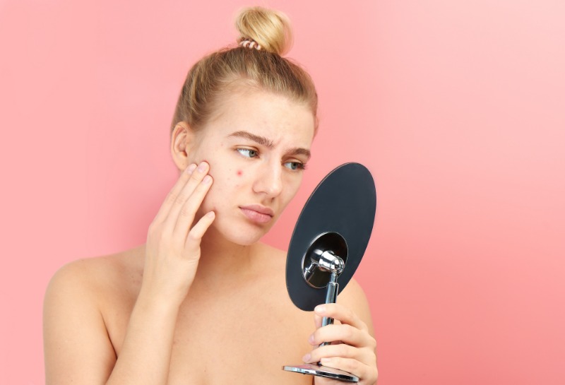 Overcoming Adult Acne
