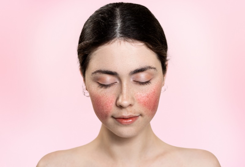 Rosacea Triggers and How to Avoid Them for Clearer Skin
