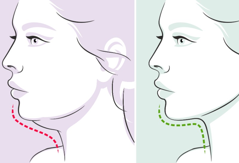 Say Goodbye to Your Double Chin!