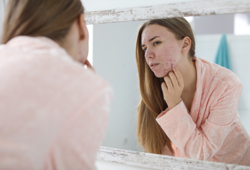 Seasonal Variations in Acne