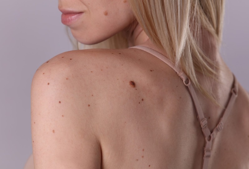 Everything You Need to Know About Skin Tags