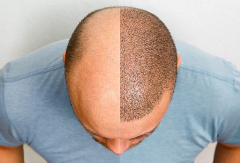 The Latest on Hair Transplants - FUE Versus FUT