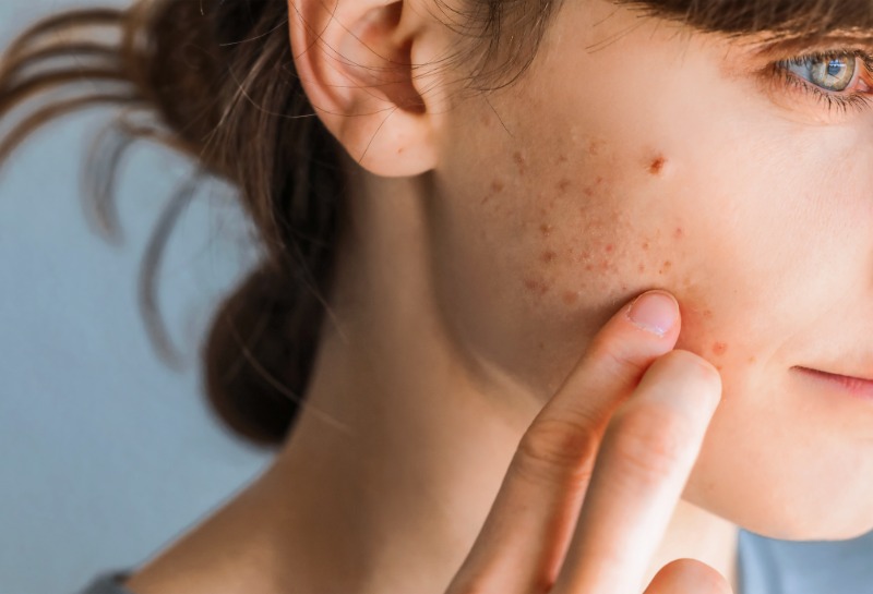The Real Face of Acne and Scarring