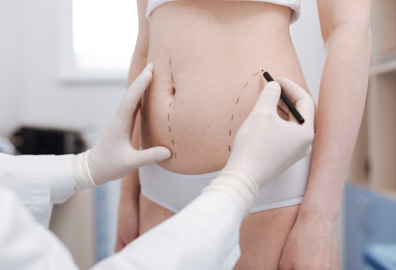 Treating Lipoedema: MicroLipo vs. Traditional Liposuction