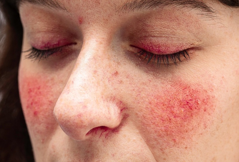 Treating Rosacea With Skin Creams