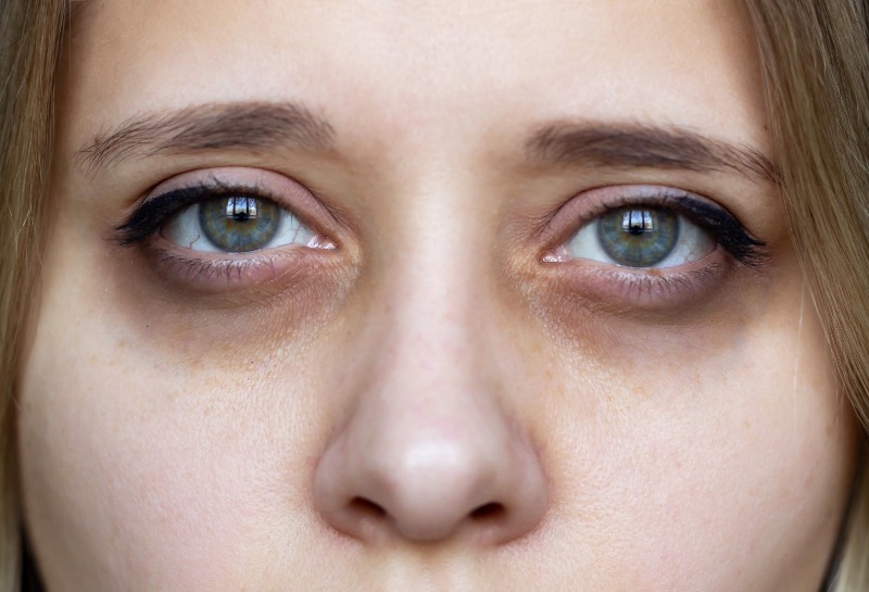 What Are Dark Under Eye Circles, How Can You Treat Them?