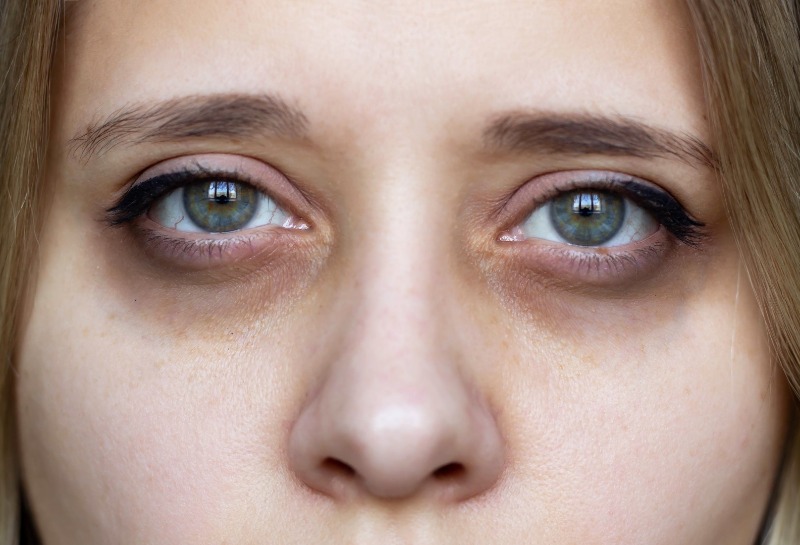 What Are Dark Under Eye Circles, How Can You Treat Them?