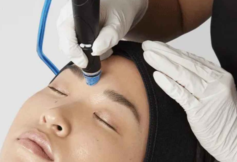 What Is Hydrafacial and How Does It Work?