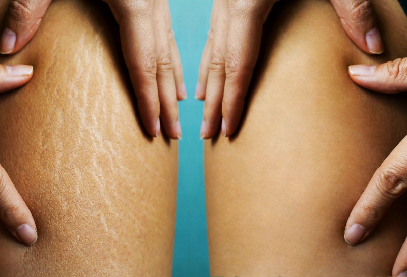 Why Do Some Stretch Mark Creams Work?