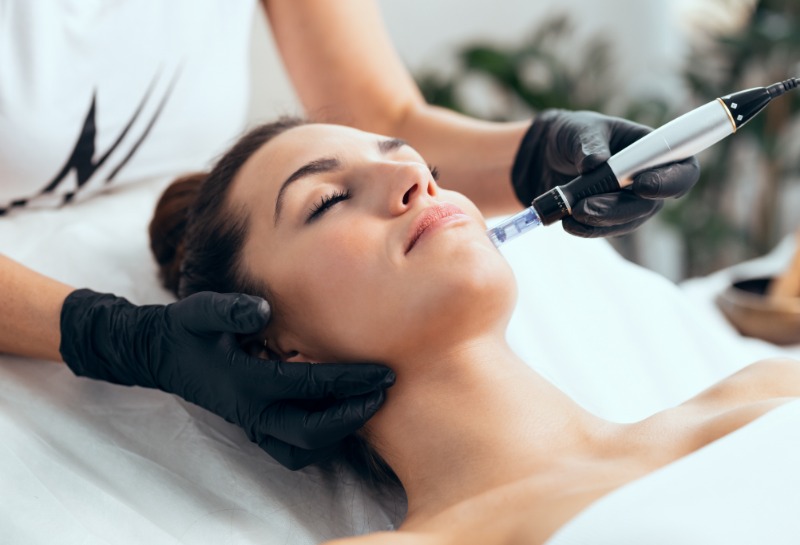 Why I’m Obsessed With Skinpen Micro-Needling