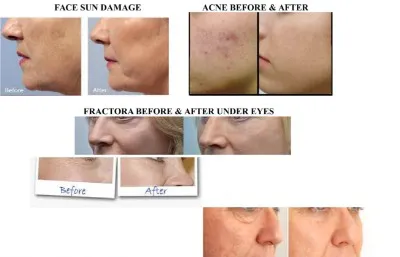 Acne Treatment Photo